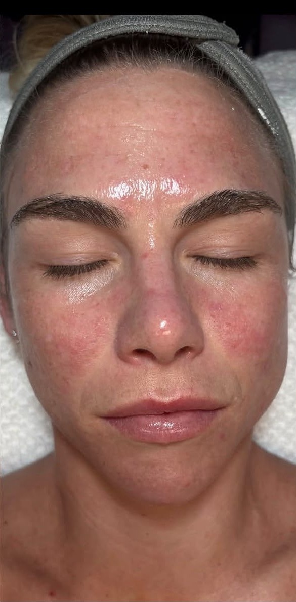 Client 1, front view — after treatment