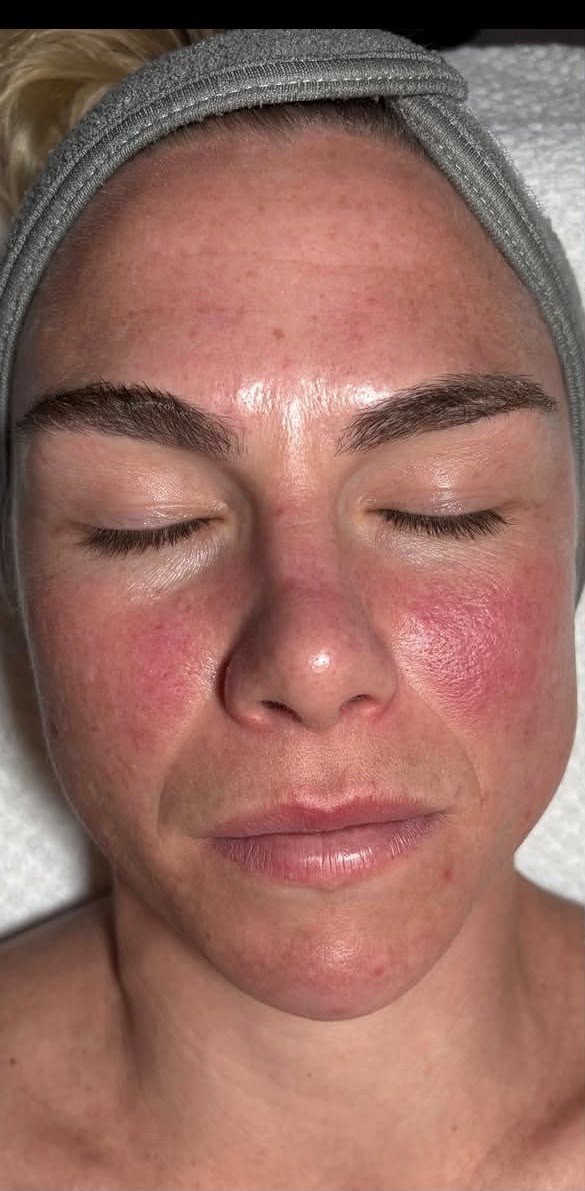 Client 1, front view — before treatment