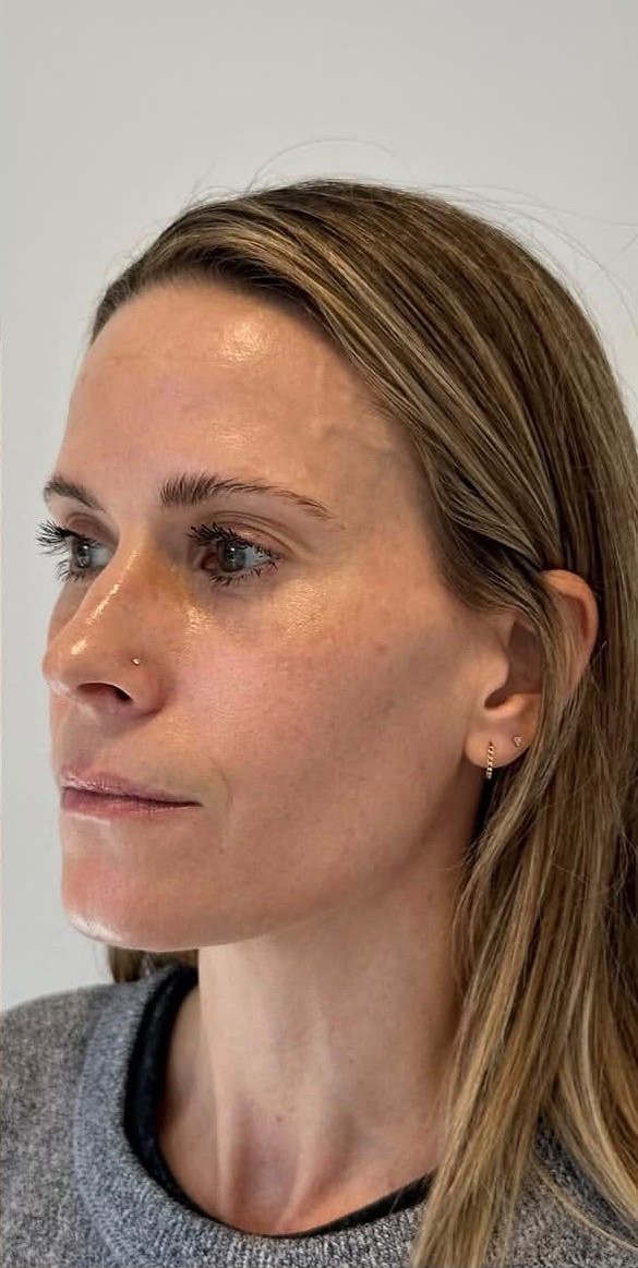 Client 2, three-quarter profile — after treatment