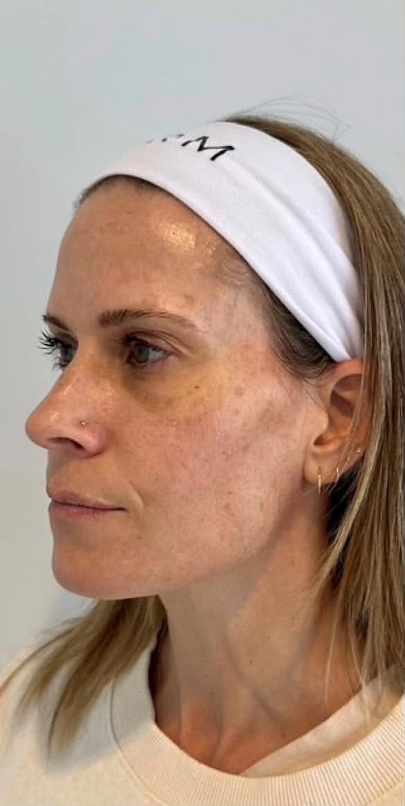 Client 2, three-quarter profile — before treatment