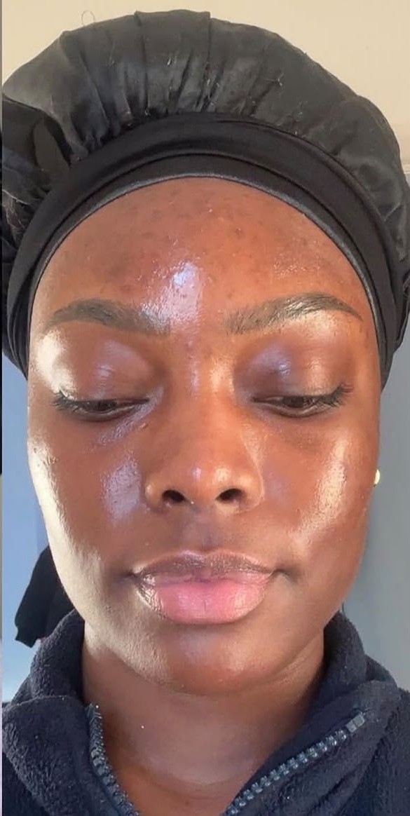 Client 3, front view — after treatment