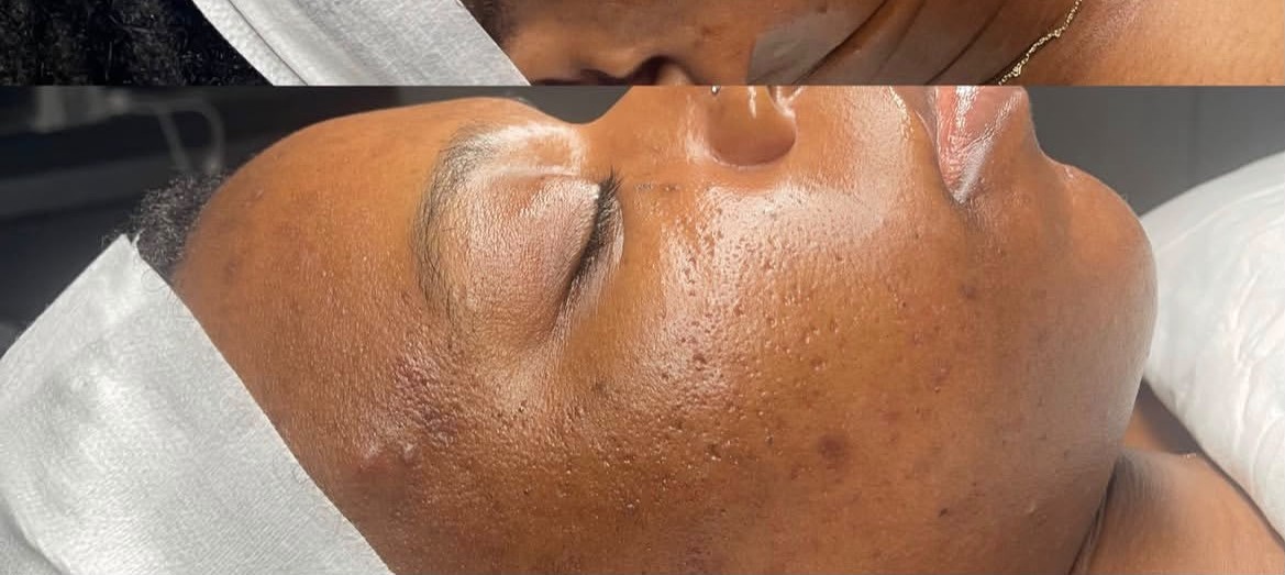 Client 4, side profile — after treatment