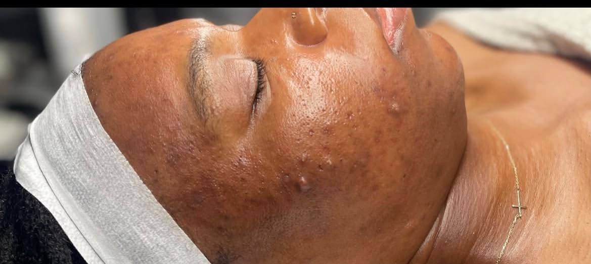 Client 4, side profile — before treatment