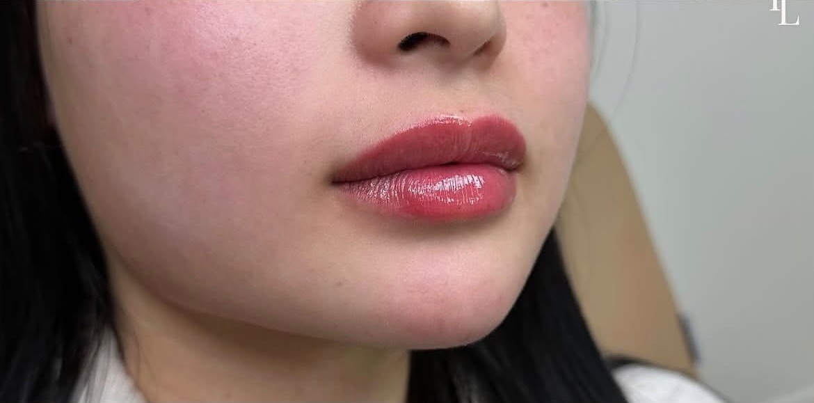 Client 5, lips close-up — after treatment