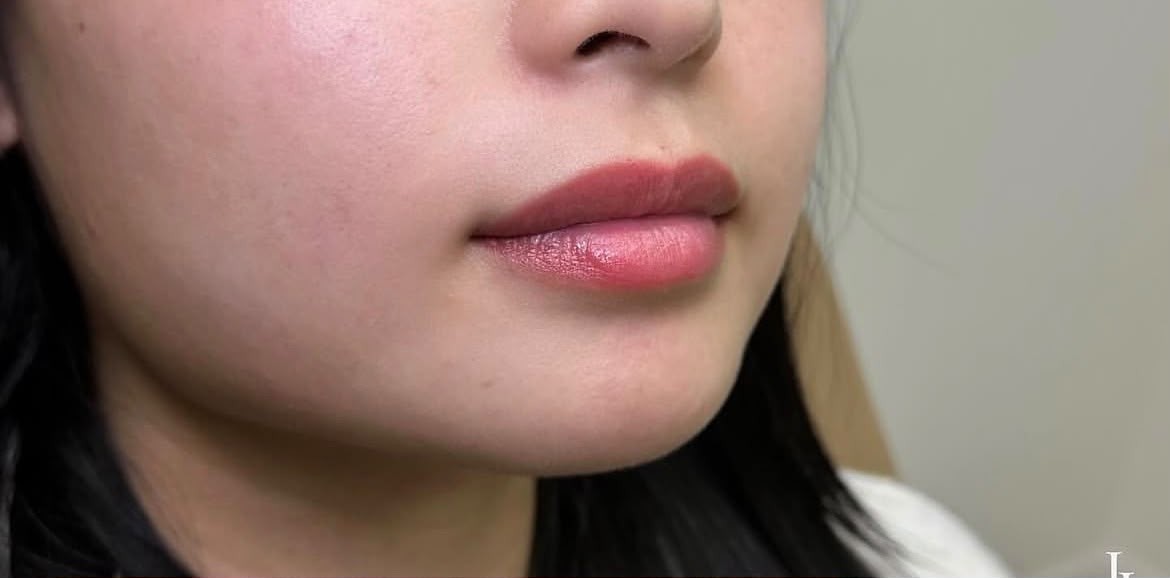 Client 5, lips close-up — before treatment