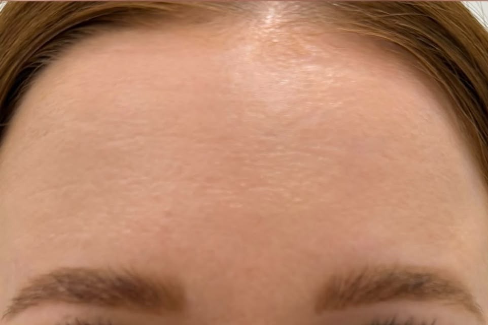 Client 6, forehead close-up — after treatment