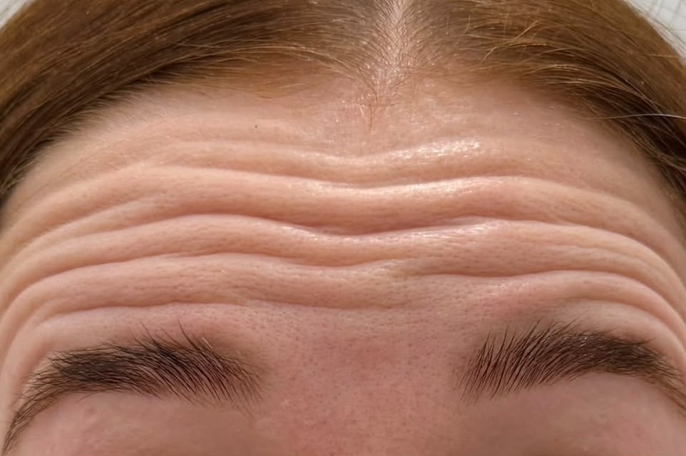 Client 6, forehead close-up — before treatment